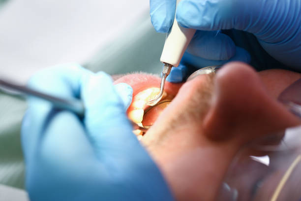 Best Emergency Root Canal Treatment in Gateway, FL